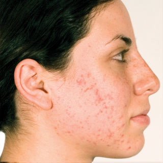 BLEMISH CLEARING™ Oil Control Skincare Clinically Validated Results Before Image: Lots of Blemishes and Redness