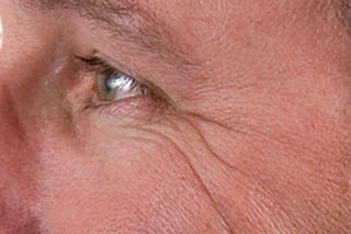 Green Apple Clinical Trial Before Image: Lines Around Eyes