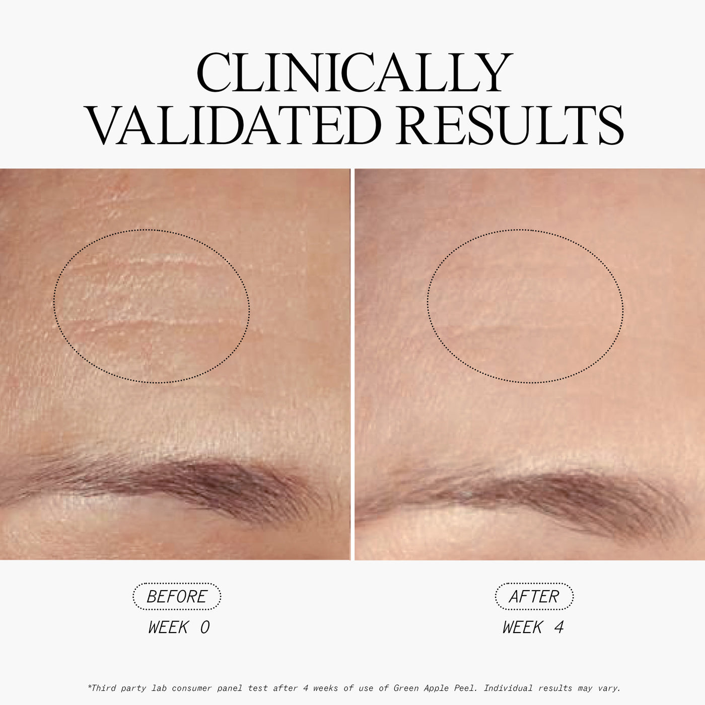 Green Apple Peel Full Strength Exfoliating Mask Clinically Validated Results