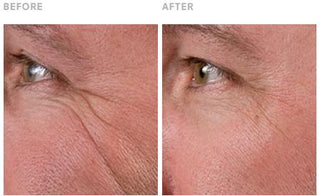 GREEN Apple Peel Clinically Validated Before and After Results: Reduced Wrinkles Around Eyes