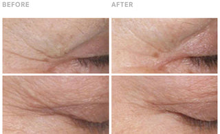 Clinically Validated Results: Reduced Wrinkles Before and After images