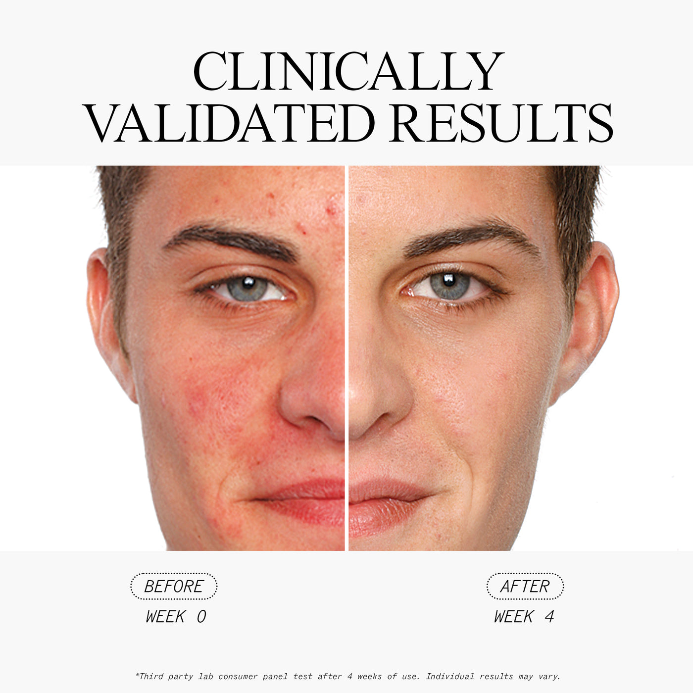 Blemish Clearing Salicylic Acid Serum Clinically Validated Results