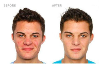 Blemish Clearing Oil Control Skincare Before and After Results: Cleared Acne