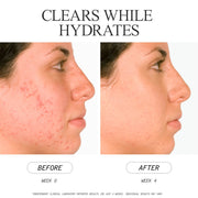 Blemish Clearing Cleanser