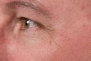Green Apple Clinical Trial After Image: Reduced Lines Around Eyes