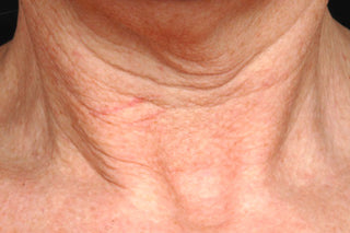 STEM CELLULAR™ Anti-Wrinkle Lifting Neck Cream Clinically Validated Results: Before, lots of wrinkles