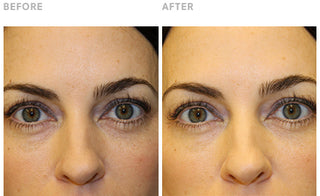 Instant Eye Lift Clinical Results: Less Puffiness and Brighter Eyes