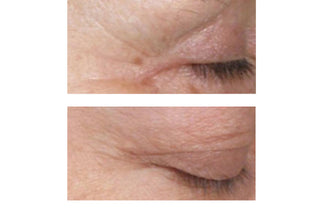 STEM CELLULAR™ Anti-Wrinkle Retinol Serum Clinically Validated Results: Before, Less Wrinkles Around the Eyes