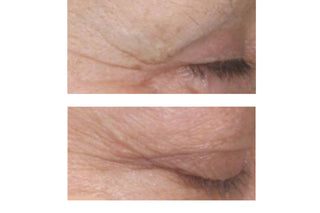 STEM CELLULAR™ Anti-Wrinkle Retinol Serum Clinically Validated Results: Before, Lots of Wrinkles Around the Eyes